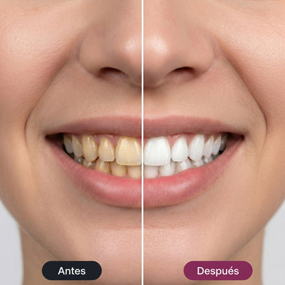 Tiras blanqueadoras dentales ValoraBeauty